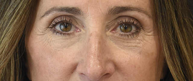 Eyelid Surgery Patient 31 Set 1 After
