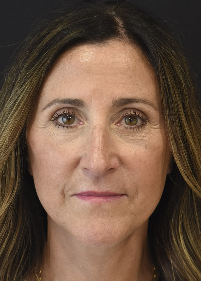 Deep Plane Facelift Patient 43 Set 1 After